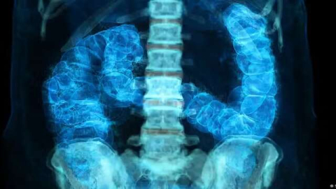  Entenda os fatores de risco do câncer colorretal, que avança entre jovens