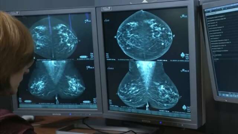 Projeções sobre o câncer de mama geram alerta: ‘As mulheres não estão fazendo a mamografia’