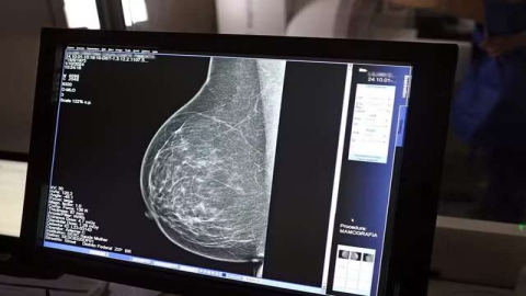 IA pode identificar risco de doenças cardíacas graves a partir de mamografias; entenda relação