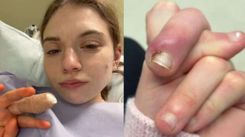 Infecção grave causada por roer unhas quase leva jovem de 21 anos à amputação