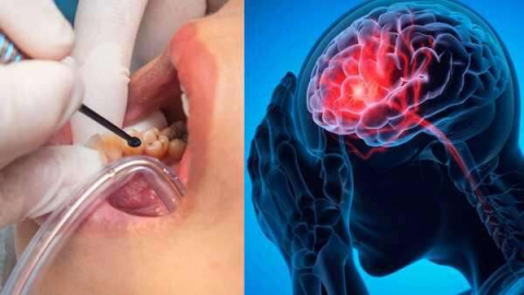 O que cárie e gengivite têm a ver com AVC? Estudo indica aumento significativo no risco de derrame