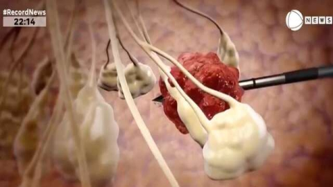 Técnica que congela tumor surge como alternativa para tratamento de câncer de mama