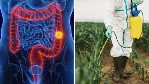 Estudo liga câncer colorretal em pessoas antes dos 50 anos à exposição a pesticidas e aponta herbicida como fator de risco