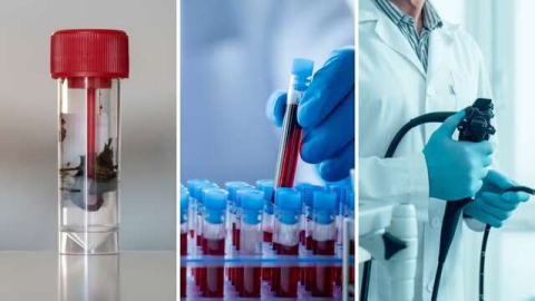 Exames de fezes e sangue se juntam à colonoscopia como opções para rastreamento de câncer colorretal