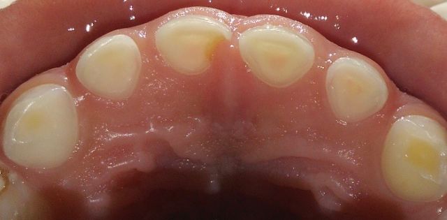dentes