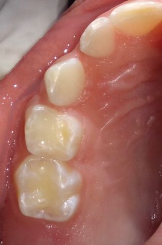 dentes1