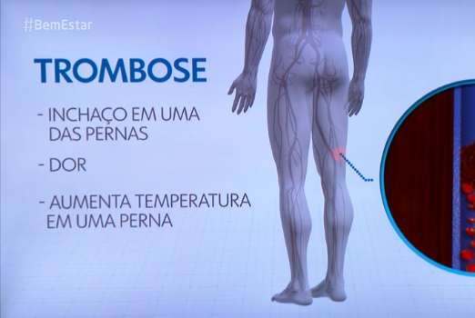 trombose