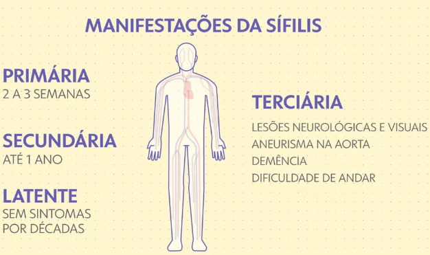 sifilis