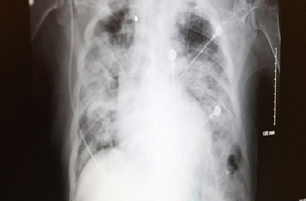Casos graves de covid-19 podem piorar com pneumonia bacteriana | Piaui Noticias