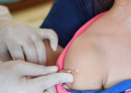 vacntuberculose