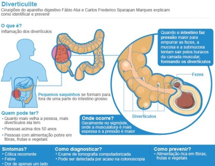 diverticulite10122012